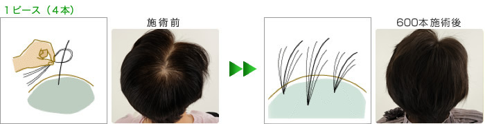 アプランタッチ増毛システム