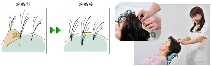 アプランタッチ増毛システム
